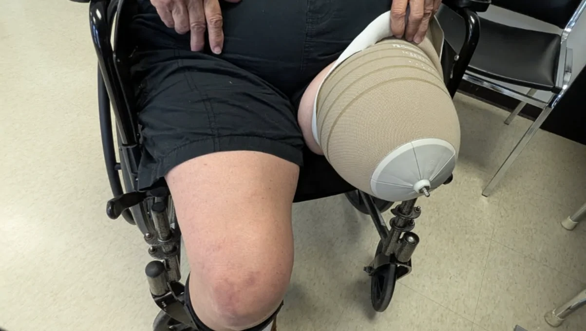 Get Lynn Walking. Assist with costs of her prosthetic leg – Fundraiser Donation Help