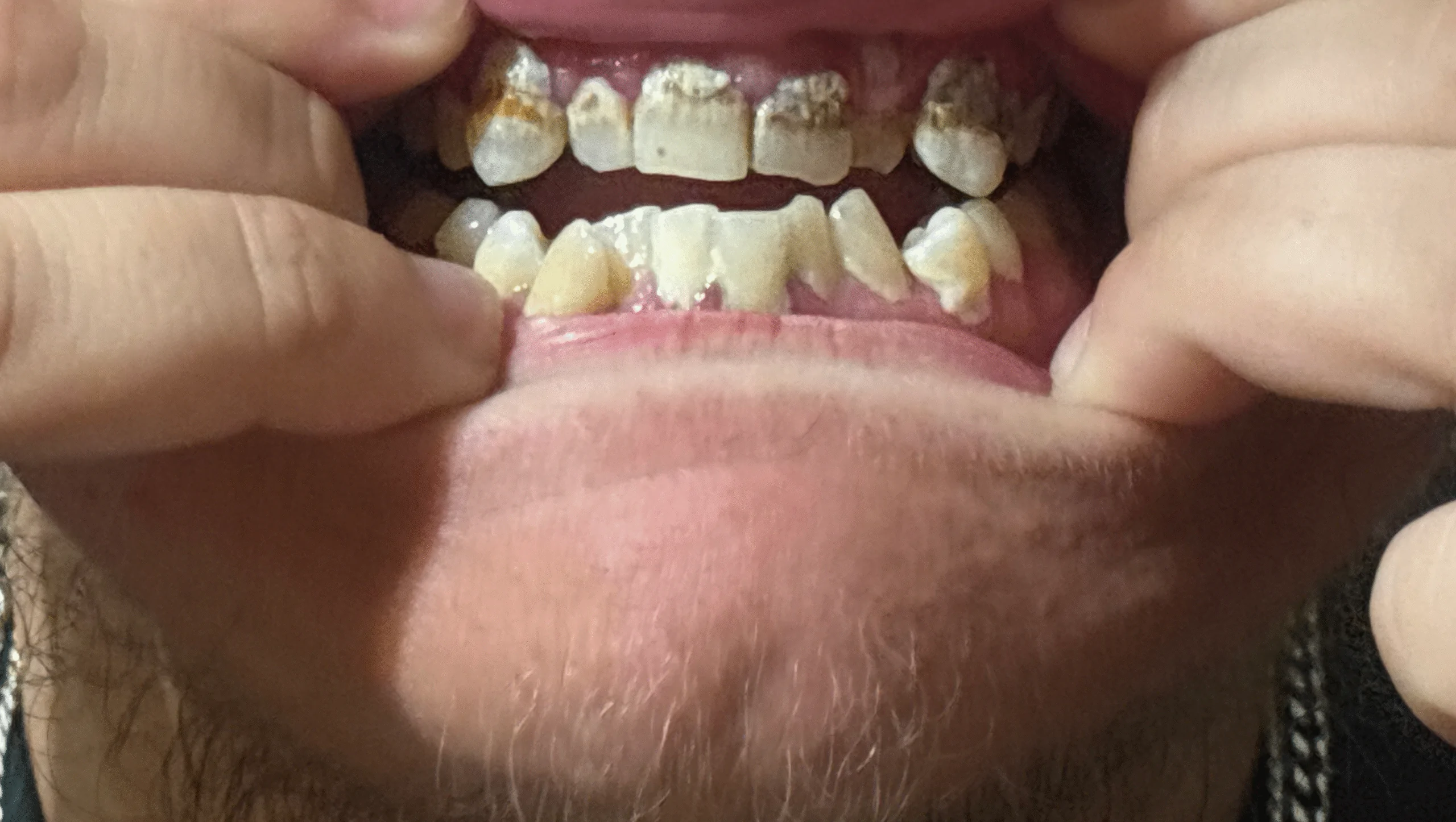 Help Tommy Smile Again: Dental Surgery Fund – GoFundMe Fundraiser gofundme Donation Help